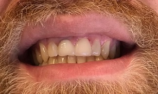 Front tooth with a crown