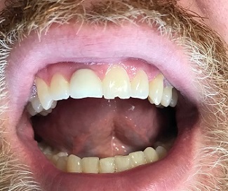 Chipped front tooth